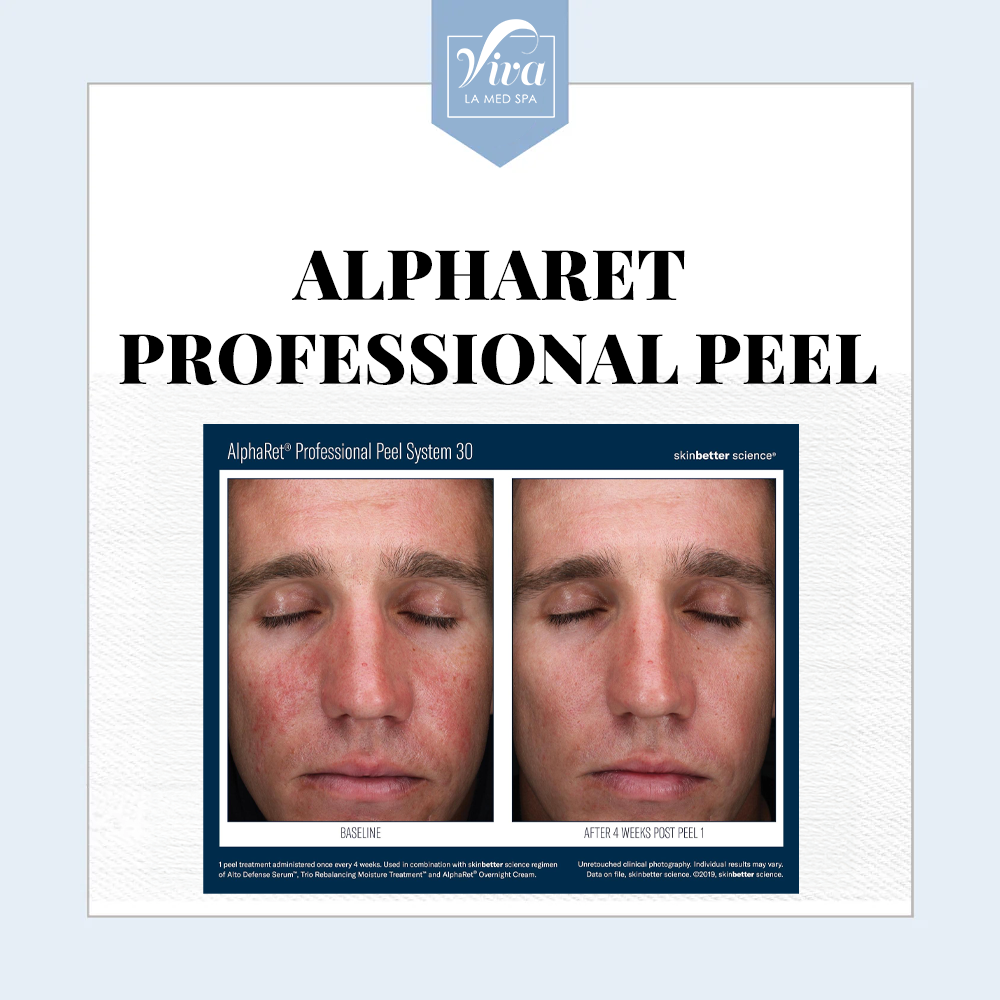 Alpharet Professional Peel