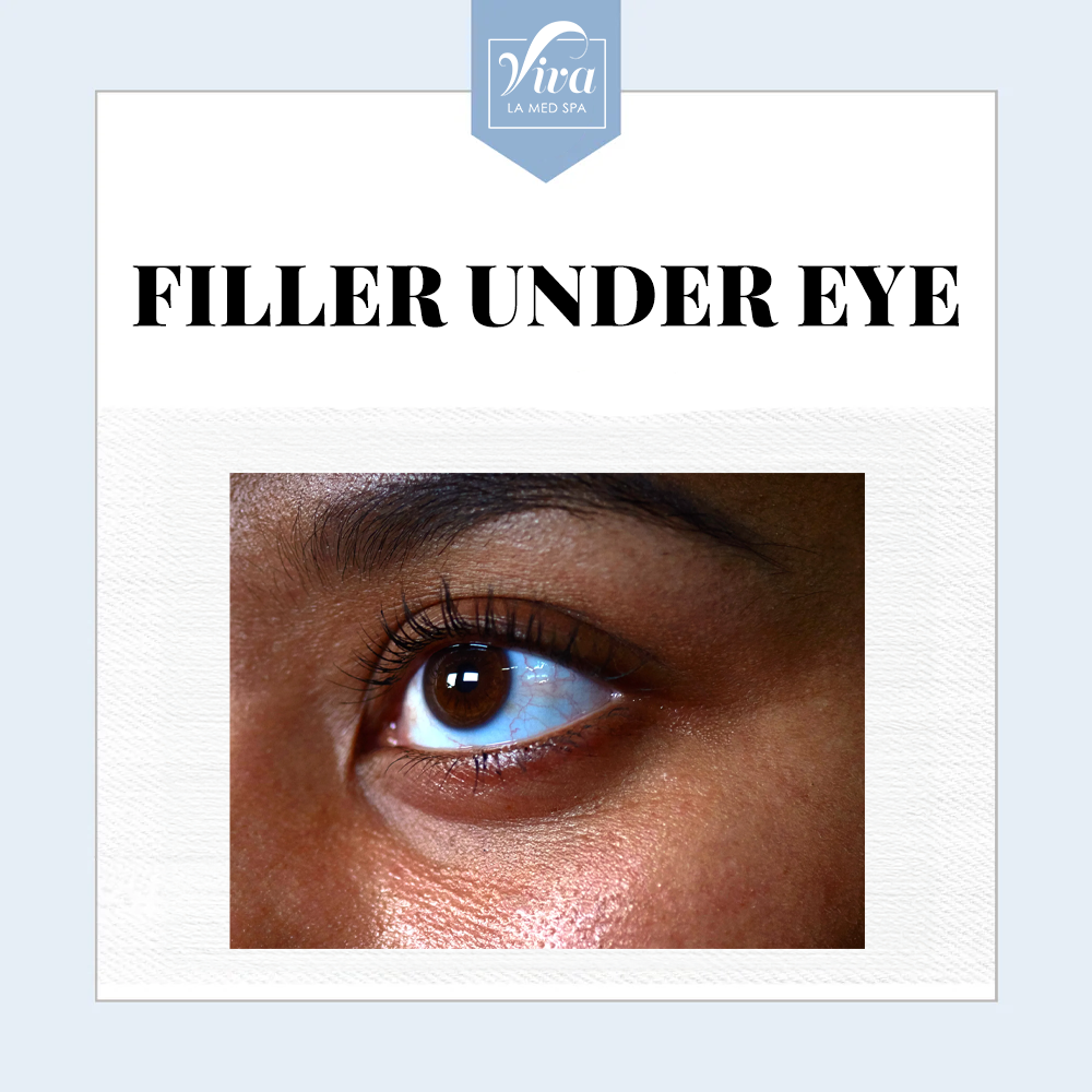 Filler Under Eye
