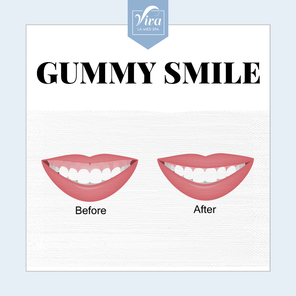 Gummy smile