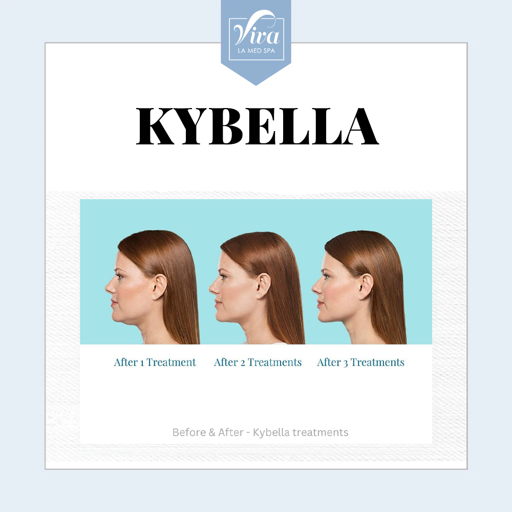 Kybella