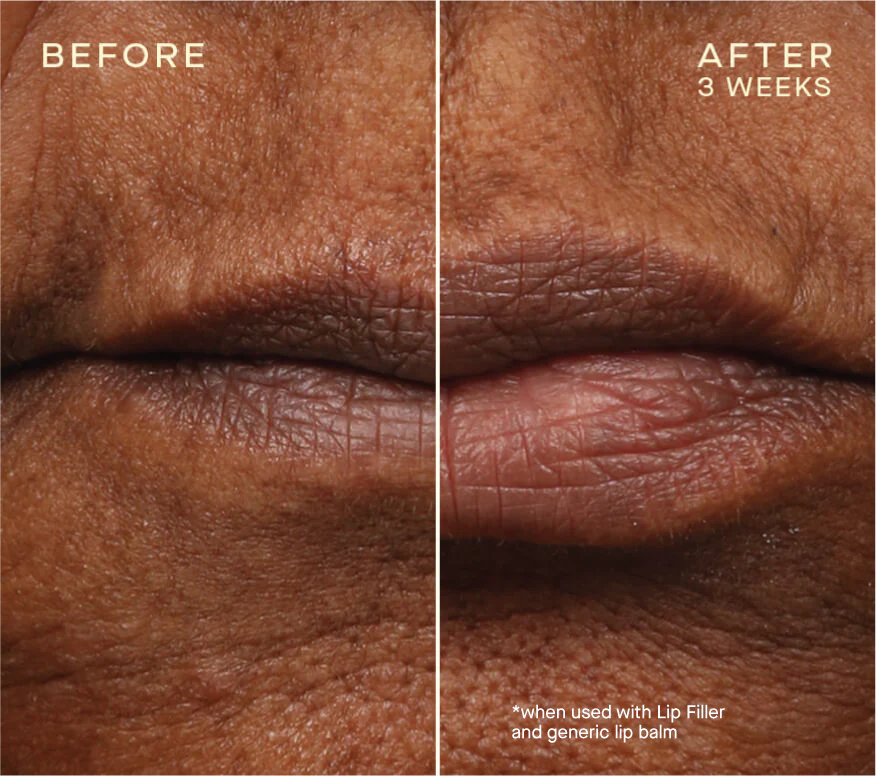 Ourself Lip Filler with Tiered-Release Vesicle™ Technology