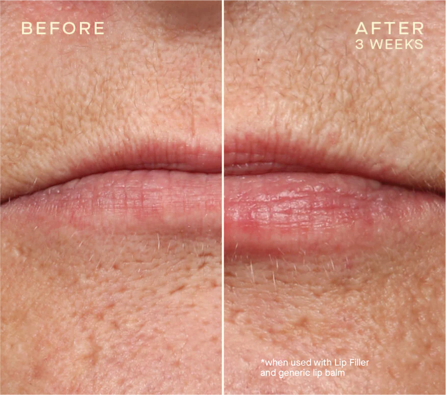 Ourself Lip Filler with Tiered-Release Vesicle™ Technology