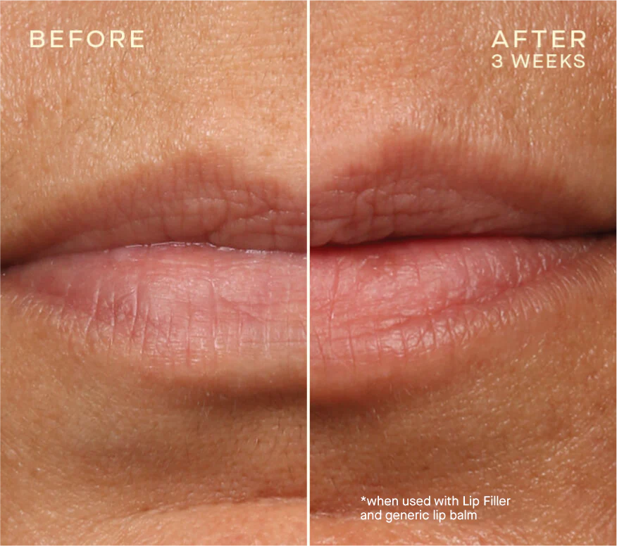 Ourself Lip Filler with Tiered-Release Vesicle™ Technology