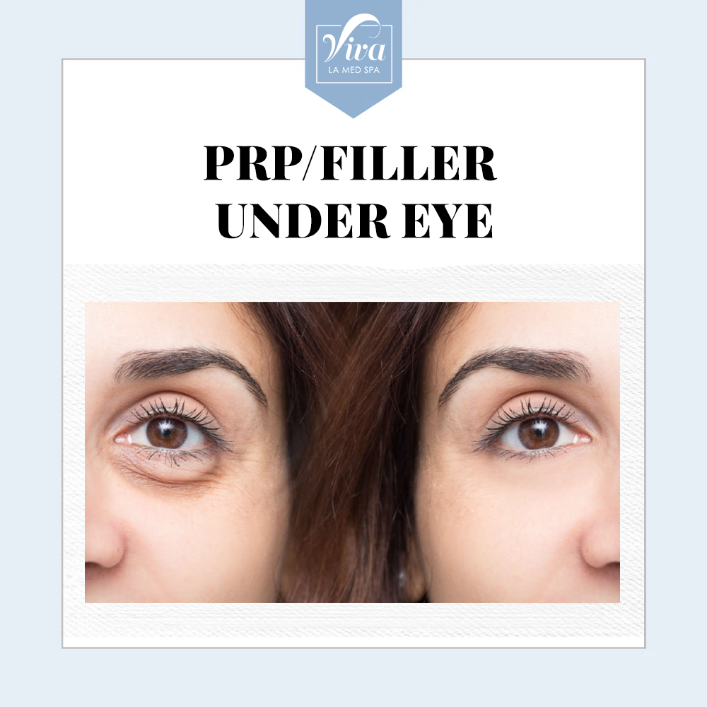 PRP/Filler Under Eye