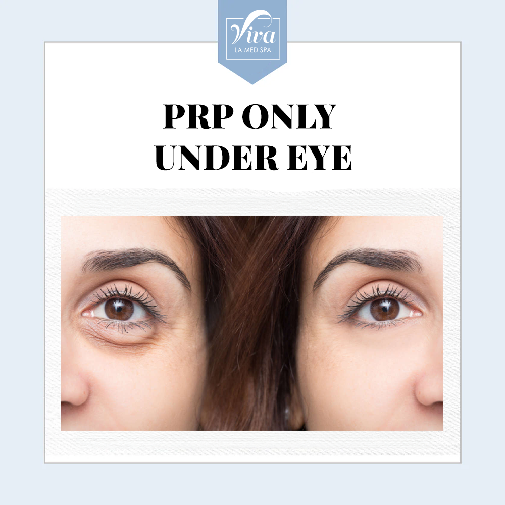 PRP only Under Eye