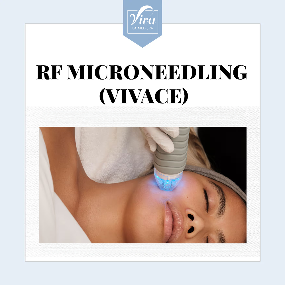 RF Microneedling (Vivace)