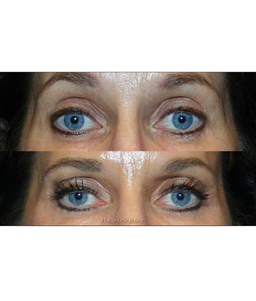 LATISSE® (bimatoprost ophthalmic solution) 3ml